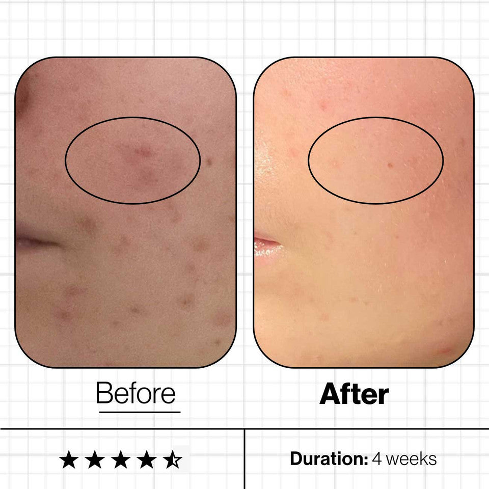 Skin Clear Biome™ 10 Days Pack